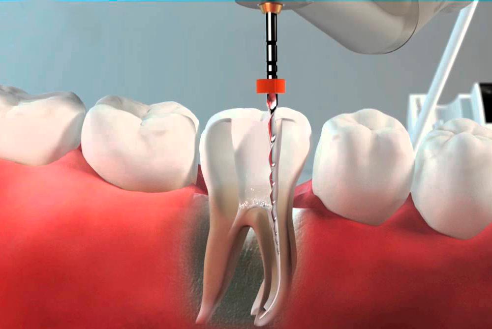 Barrancos Clínica Dental. Servicio de Endodoncias: Tratamiento de las pulpitis