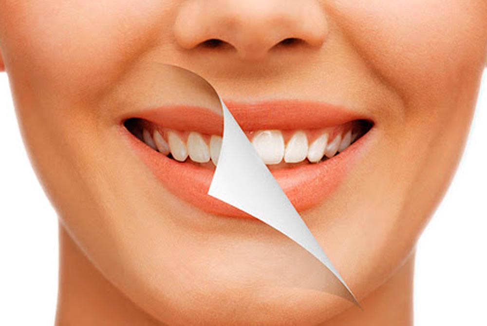 Barrancos Clínica Dental. Servicio de Estética Dental: Carillas y blanqueamientos dentales. Tratamiento de la sonrisa