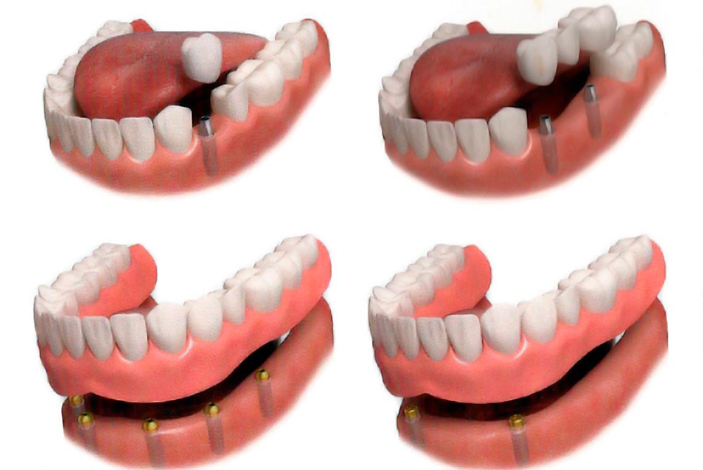 Barrancos Clínica Dental. Servicio de implantes dentales