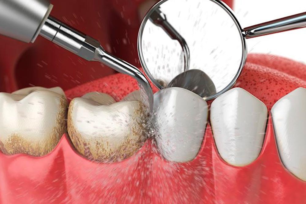 Barrancos Clínica Dental. Servicio de Limpiezas dentales, eliminación del sarro dental y de las manchas