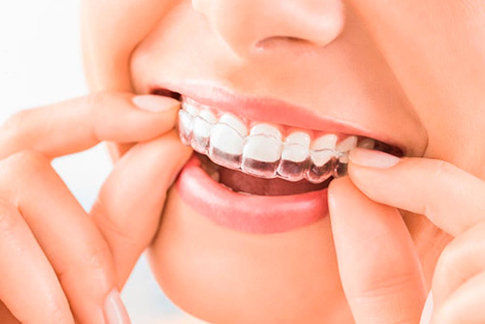Barrancos Clínica Dental. Servicio de Ortodoncia invisible