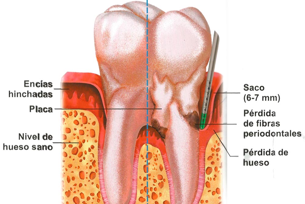 Barrancos Clínica Dental. Servicio de Periodoncia: Tratamientos de las encías. Sensibilidad dental. Ferulizaciones dentales