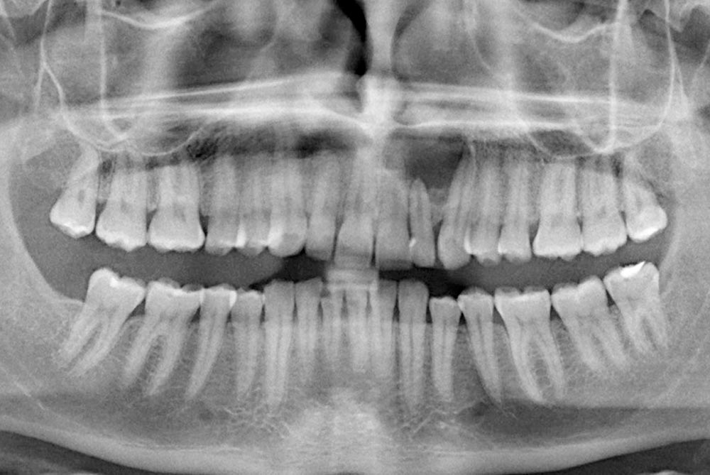 Barrancos Clínica Dental. Servicio de Radiografías: Intraorales digitales y Ortopantomografías extraorales digitales